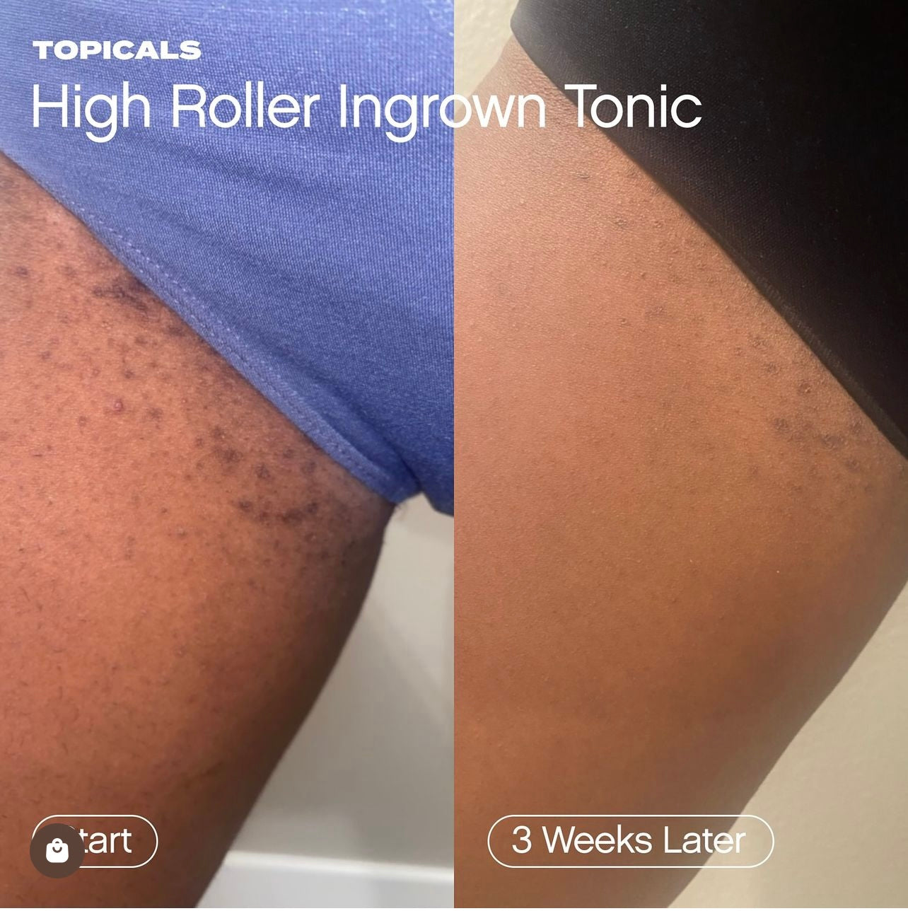 Topicals - High Roller Ingrown Tonic